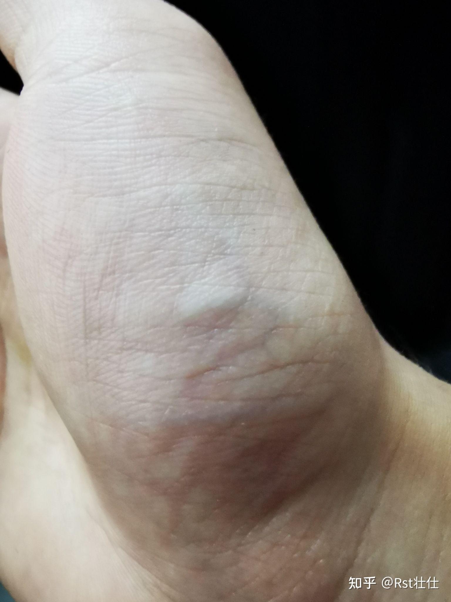 摸上去很软,不痛!