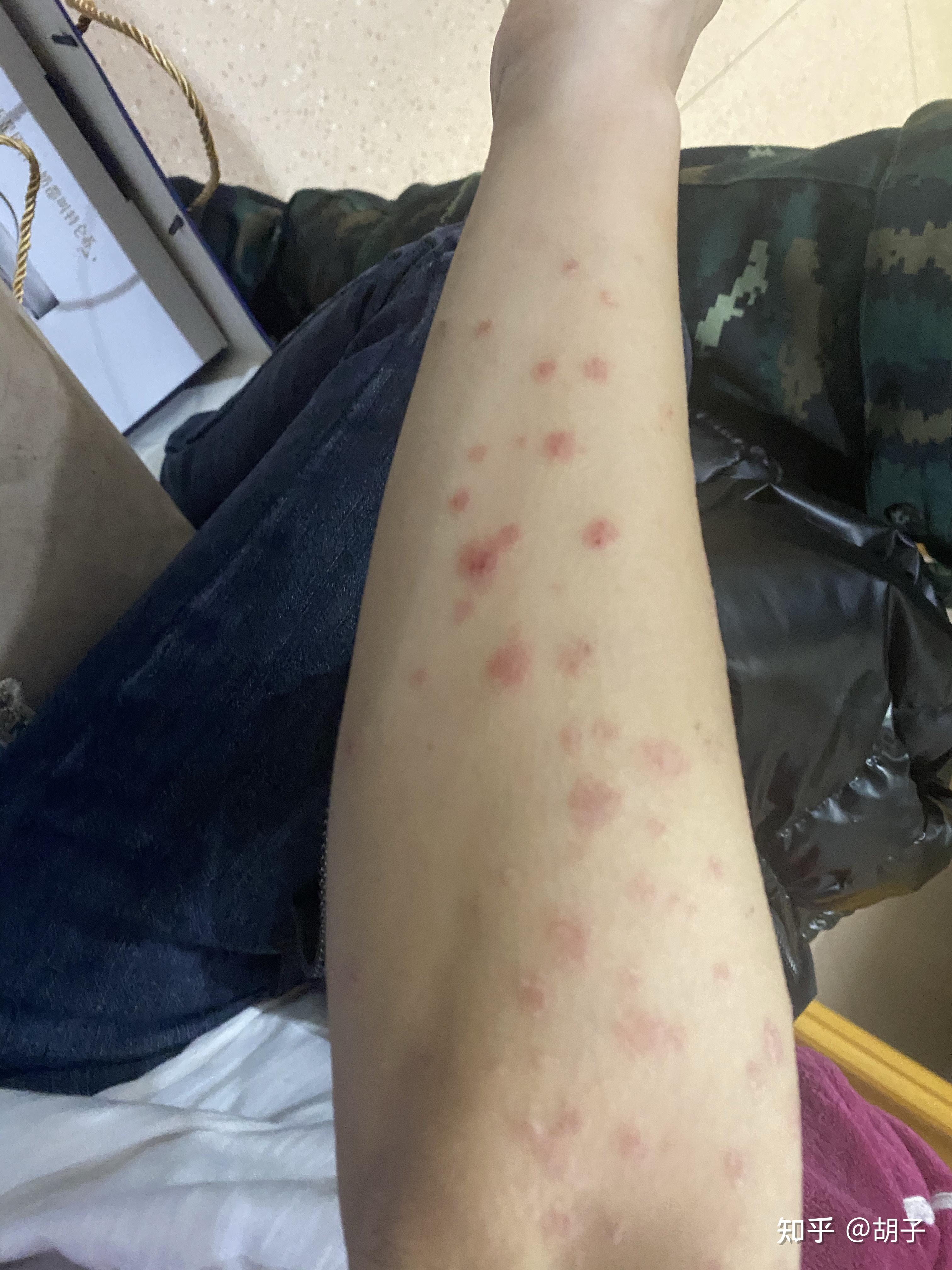 浑身都是红点点有办法解决嘛