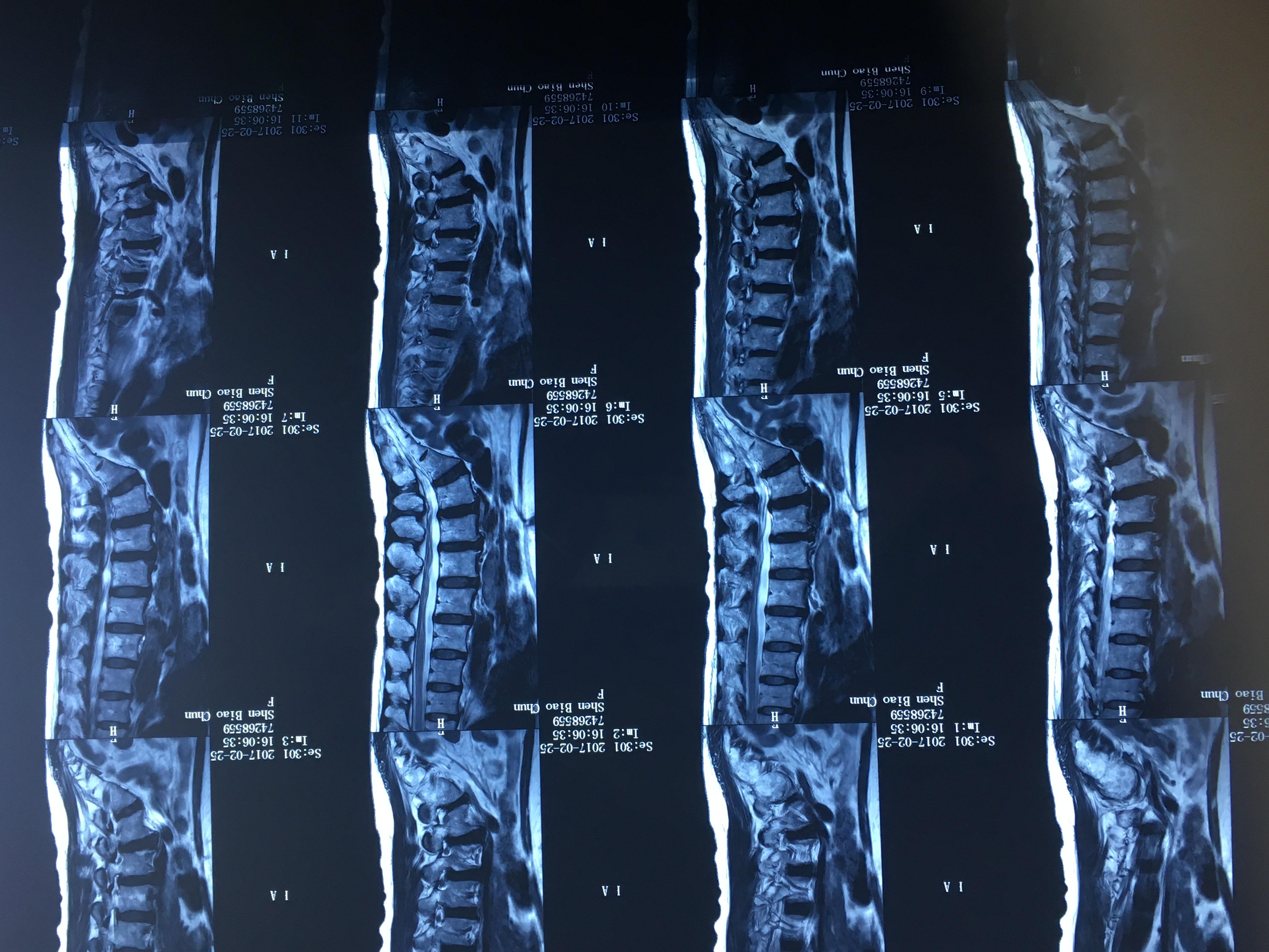 腰椎管狭窄症治疗新方法——椎间孔镜下单侧入路双侧减压 - 好大夫在线