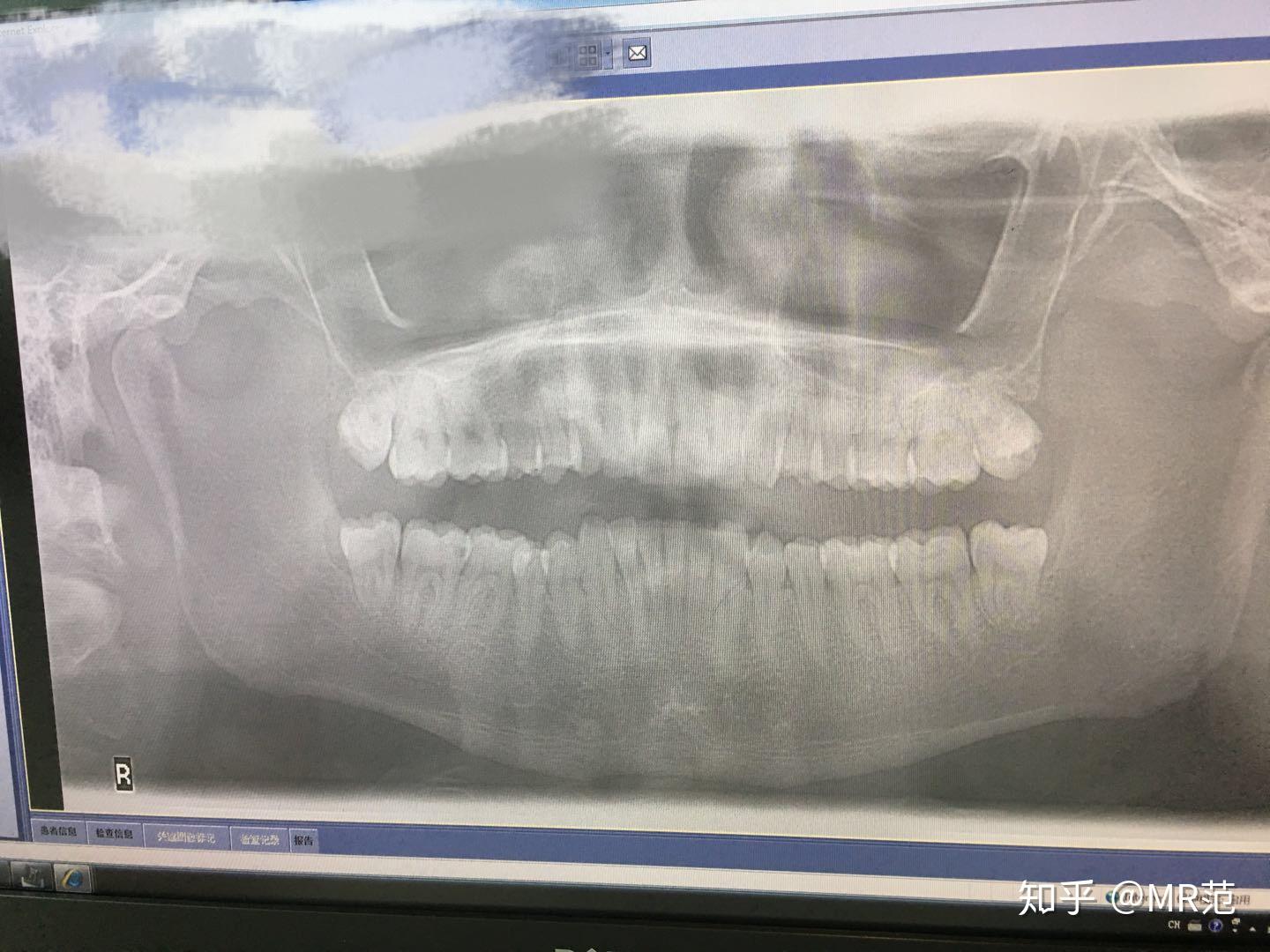 上海拔牙多少钱一颗?