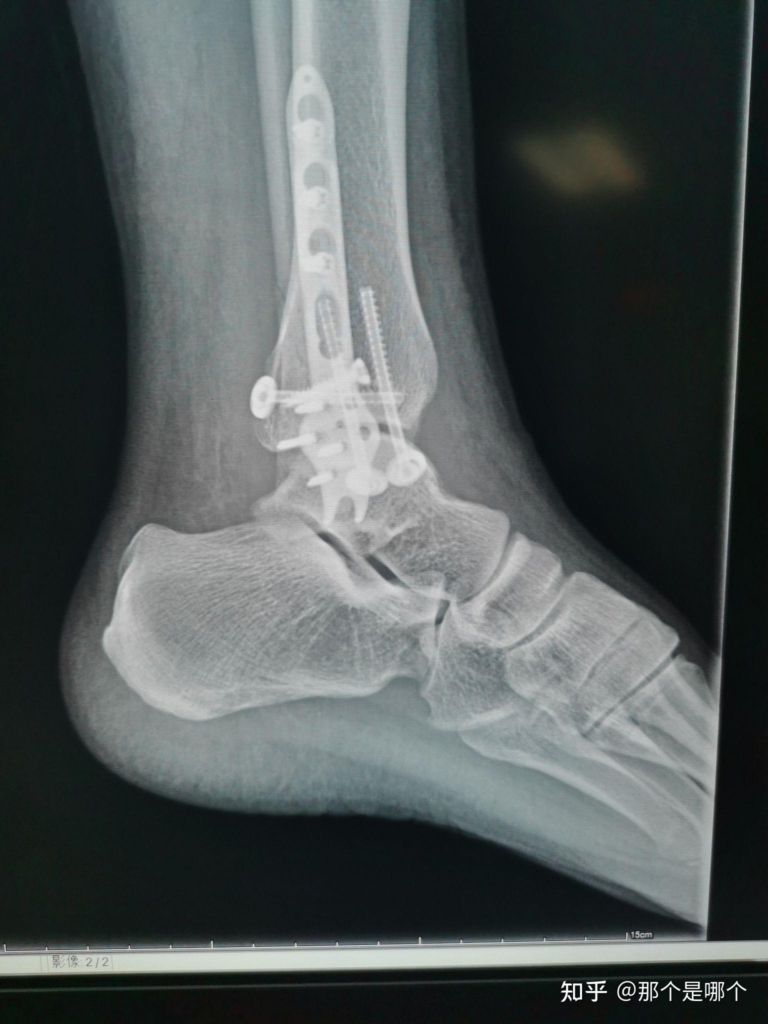 左踝关节骨折之术后一个月复查 - 知乎