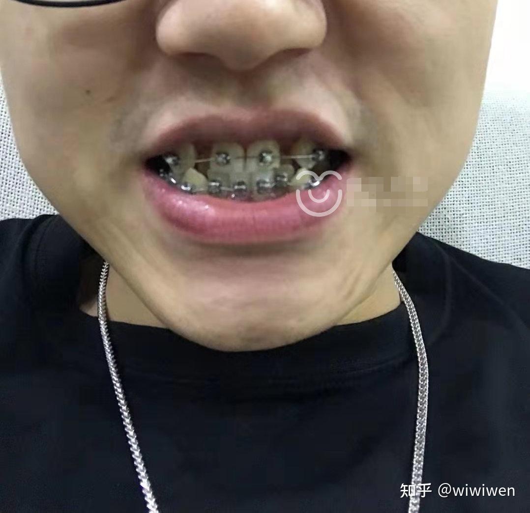 带牙套是什么感觉?