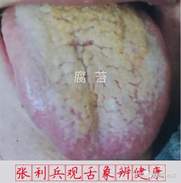 张利兵:“观舌象辨健康”第33讲--舌苔辨证诊病之腻苔与腐苔 - 知乎