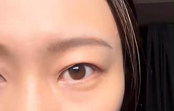 我当时都做了哪些准备,肿眼泡做双眼皮失败率高吗?