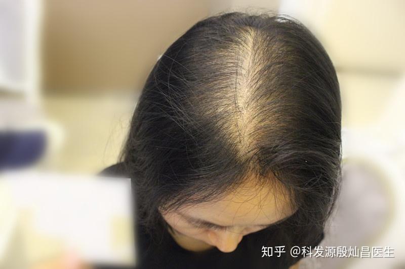 脱发原因检查