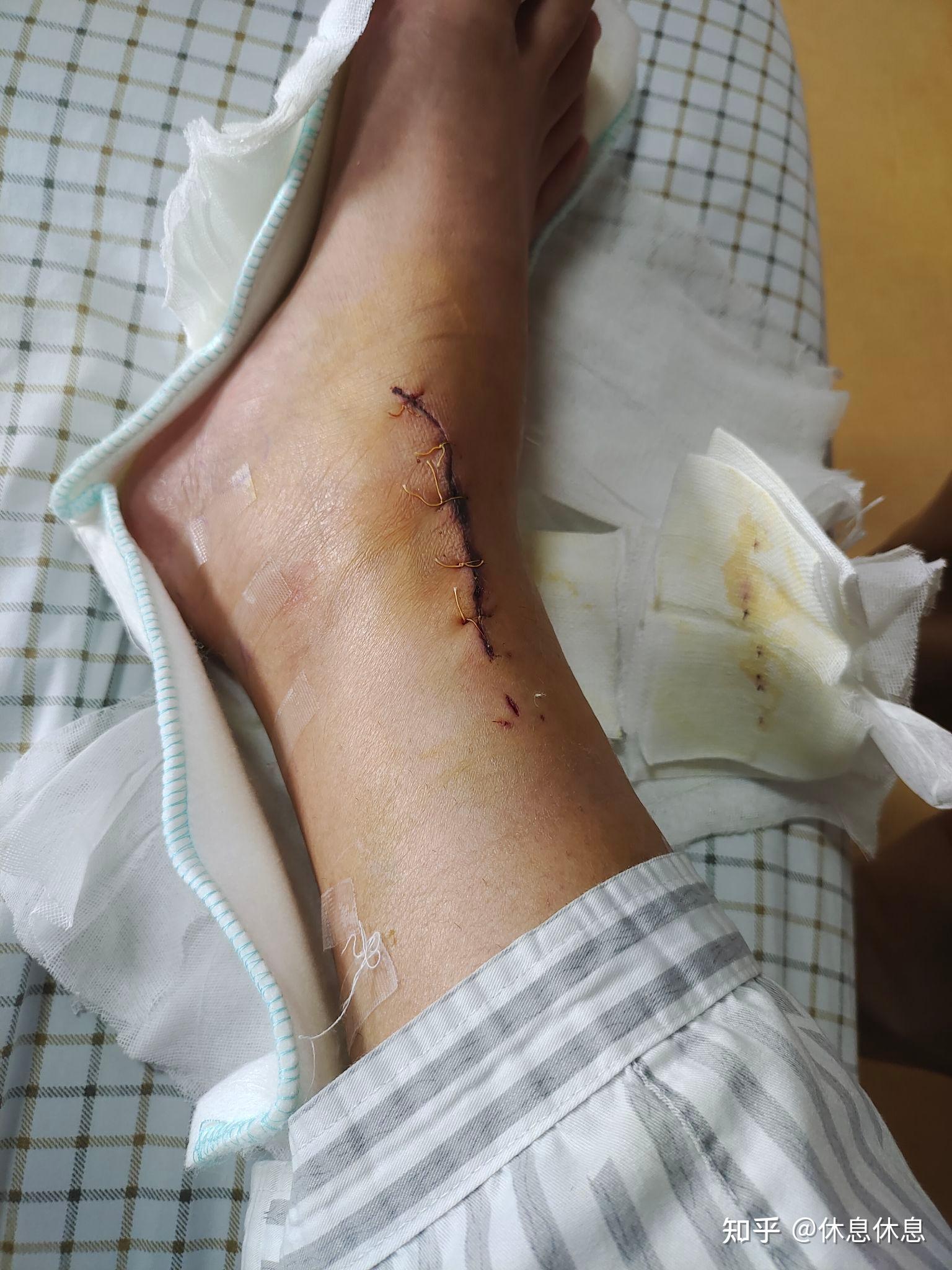 脚踝距骨植骨记