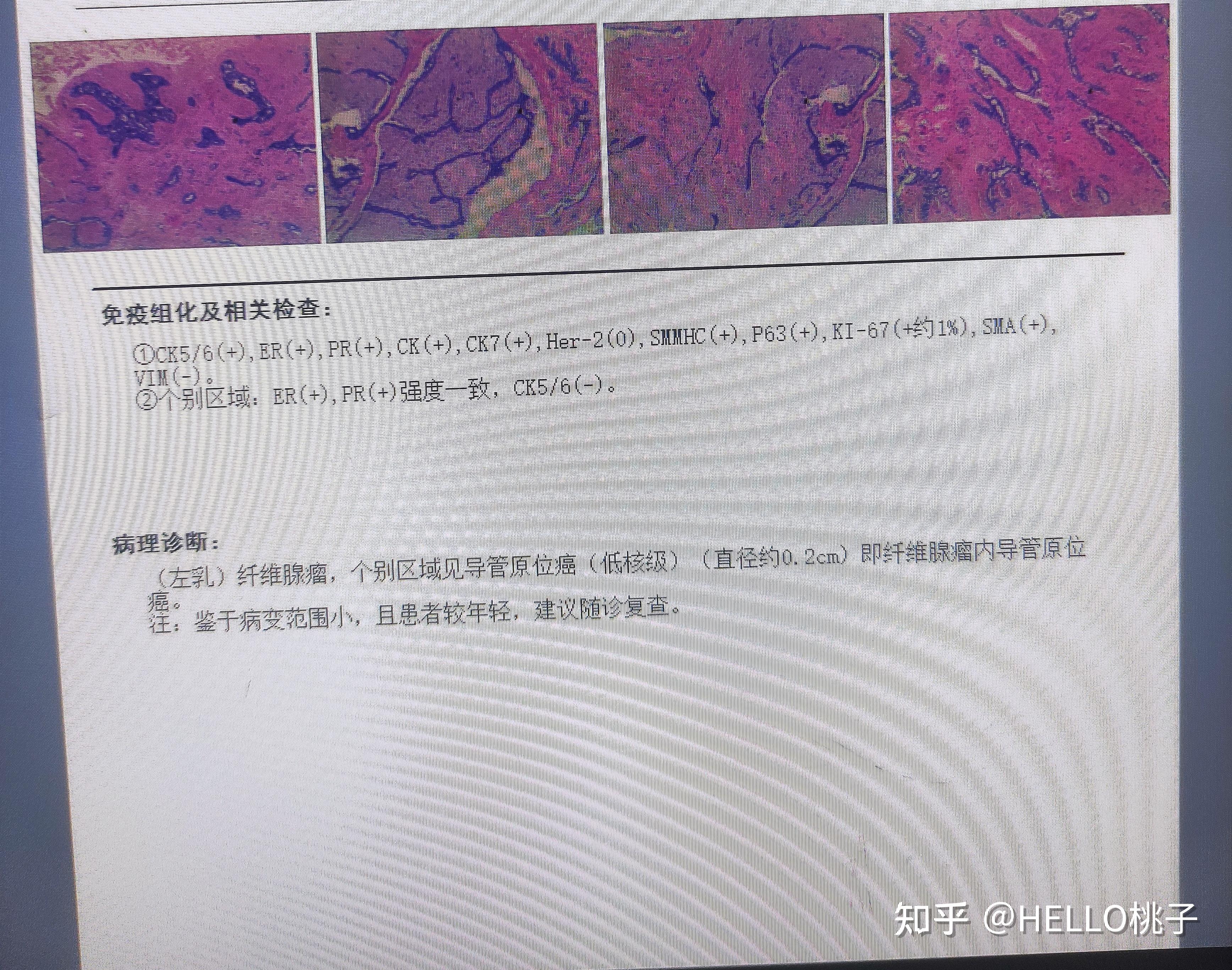 28岁乳腺导管原位癌向阳而生