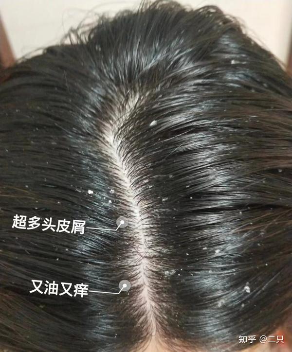 头皮屑多到一挠就跟下雪一样,怎么办? - 知乎