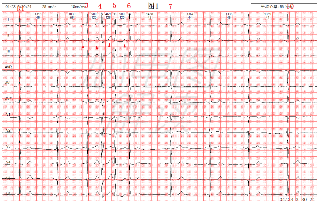 心跳过快心电图图片