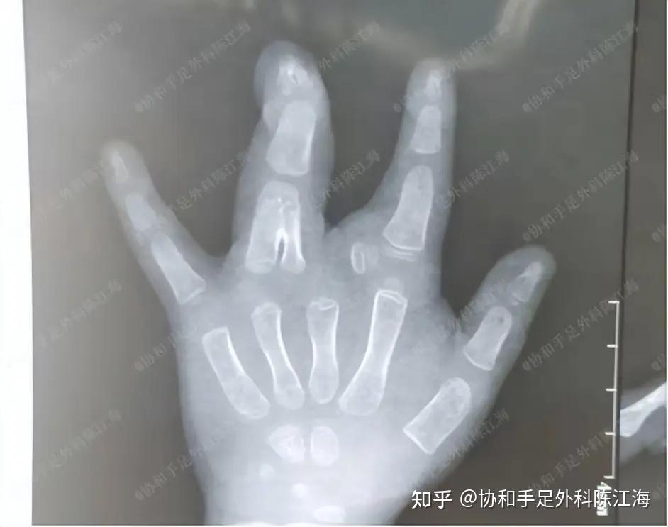 并指免植皮|案例2:男孩复杂并指,妈妈多年坚守,终四指变五指 - 知乎