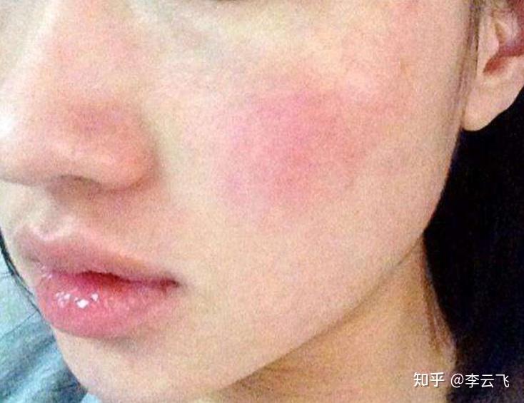 敏感皮肤怎么改善四大改善要点要谨记