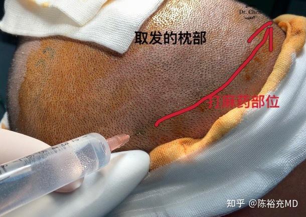 植发是怎么麻醉的