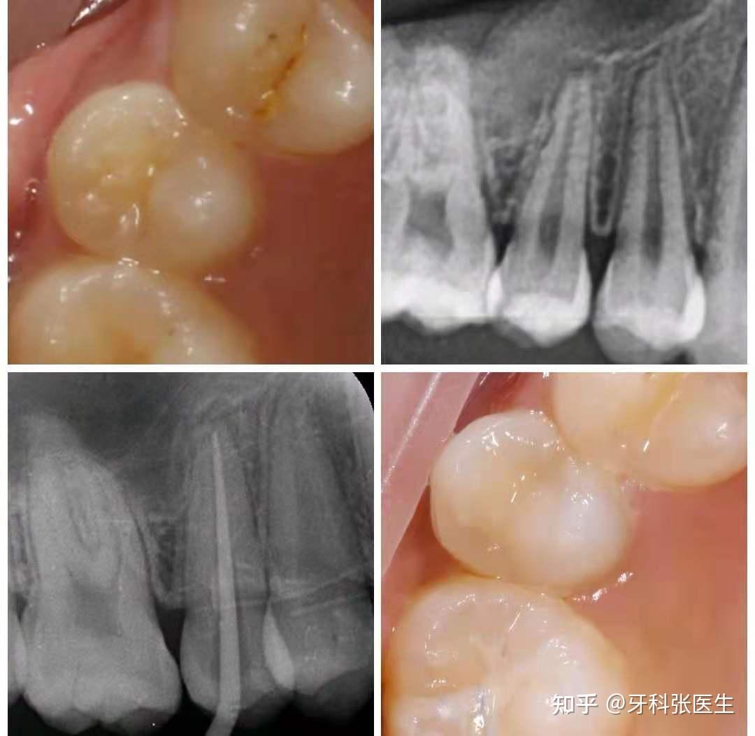 因畸形中央尖折断导致根尖周炎,根管治疗后直接树脂充填最后,有句重要
