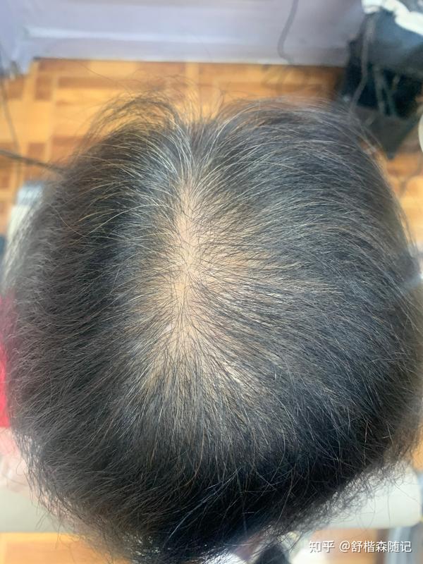 脱发和掉发常见的6大原因? - 知乎