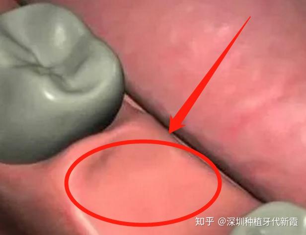 2,正式开始种植牙手术在牙槽骨上制备一个孔,植入人工种植体.