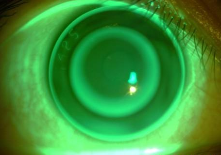 crt,ok镜,rgp的区别