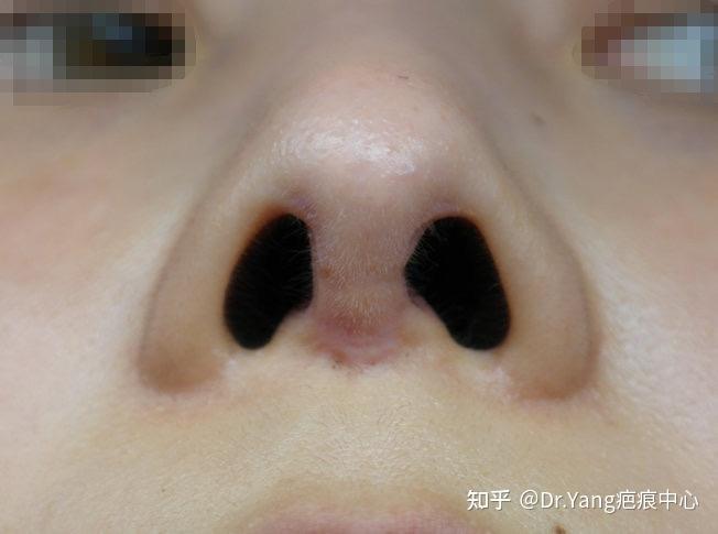 鼻小柱凹陷疤痕修复术