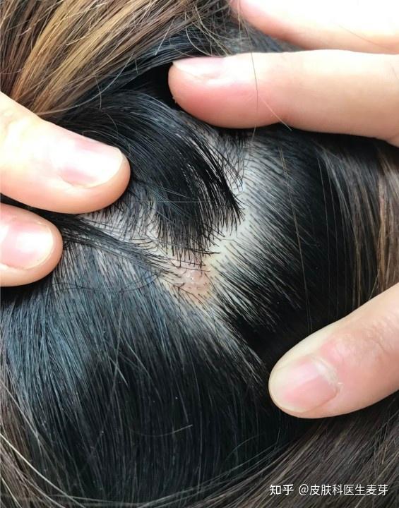 【头皮螨虫】头皮痒头皮屑掉头发都是螨虫在作祟!