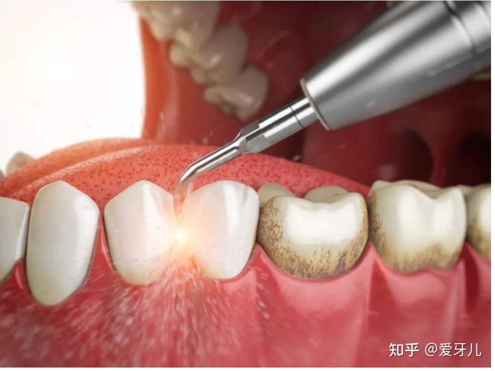 不過,在鑲牙之前也需進行洗牙及其他牙周治療,以便能維持健康的牙周