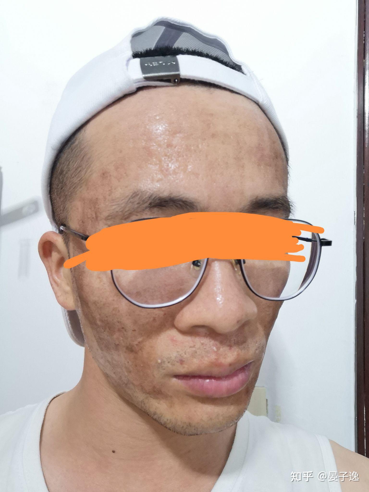 点阵激光治疗痘坑