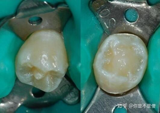 乳牙畸形中央尖图片图片