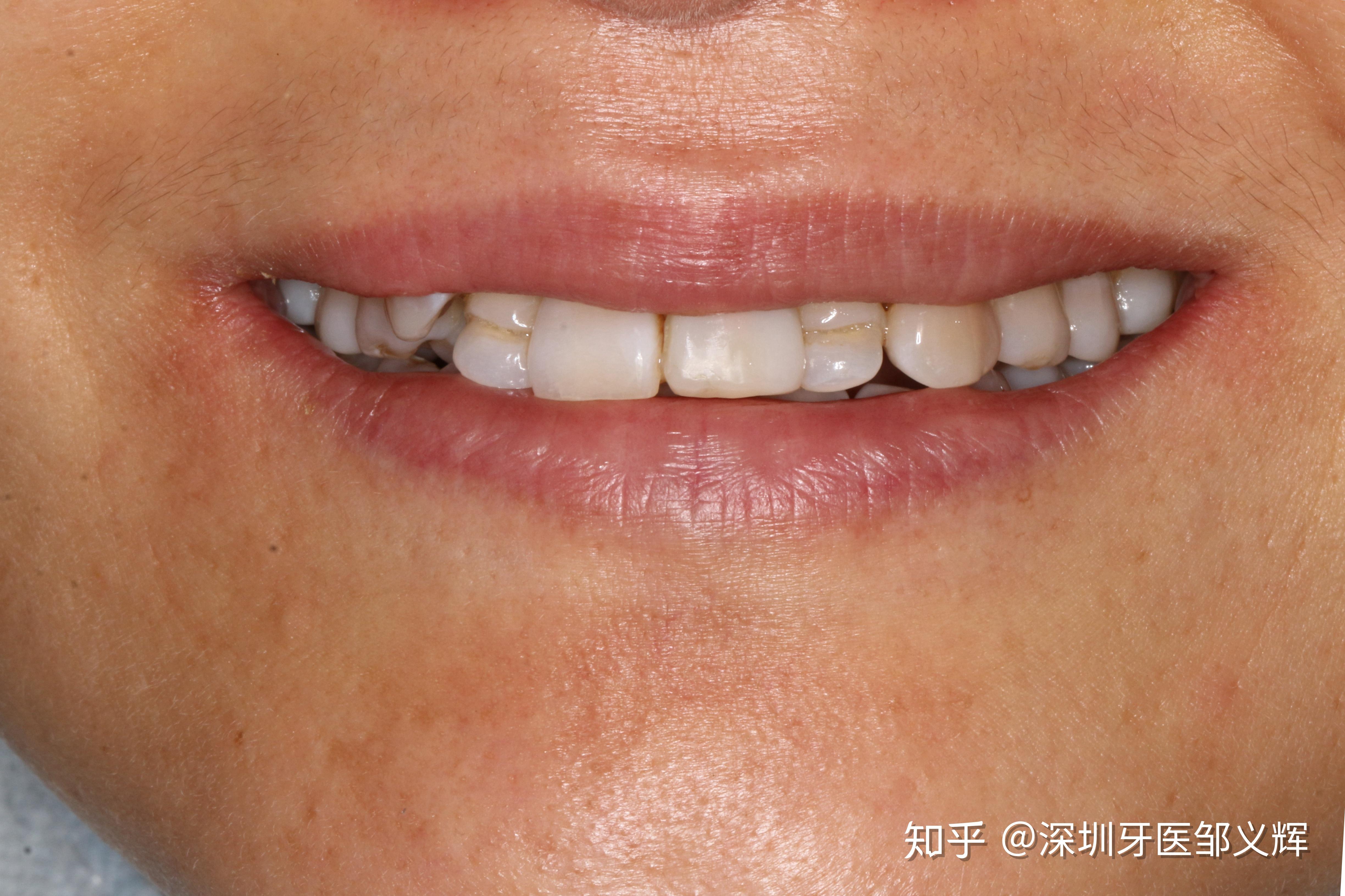 上门牙外伤即刻种植即刻修复