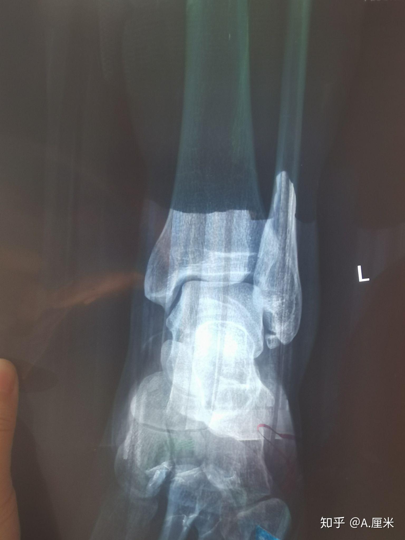 左脚外踝撕脱骨折加外侧副韧带断裂,之一保守治疗之路