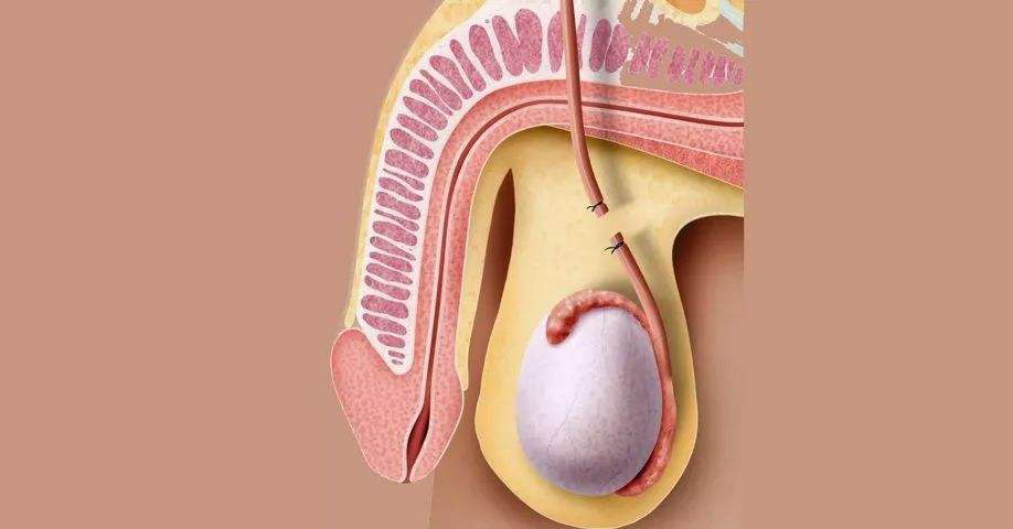 男性输精管结扎