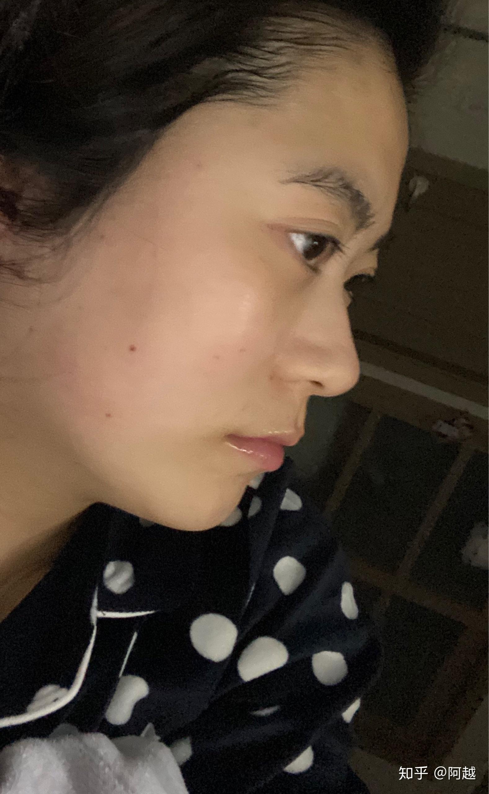 侧面看眼睛非常突眉骨低和鼻子连接不起来是怎么回事