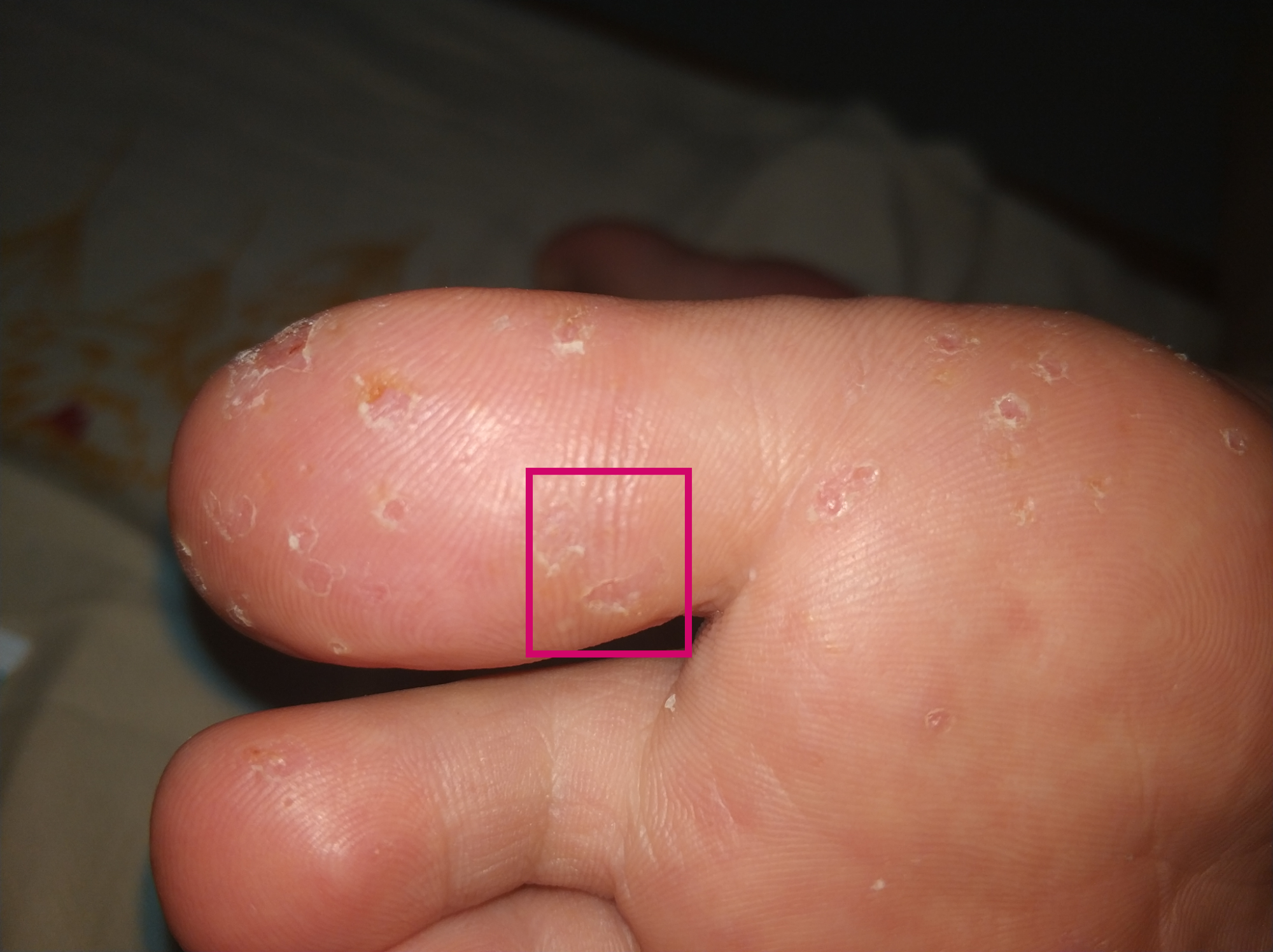 脚趾疣初期图片图片