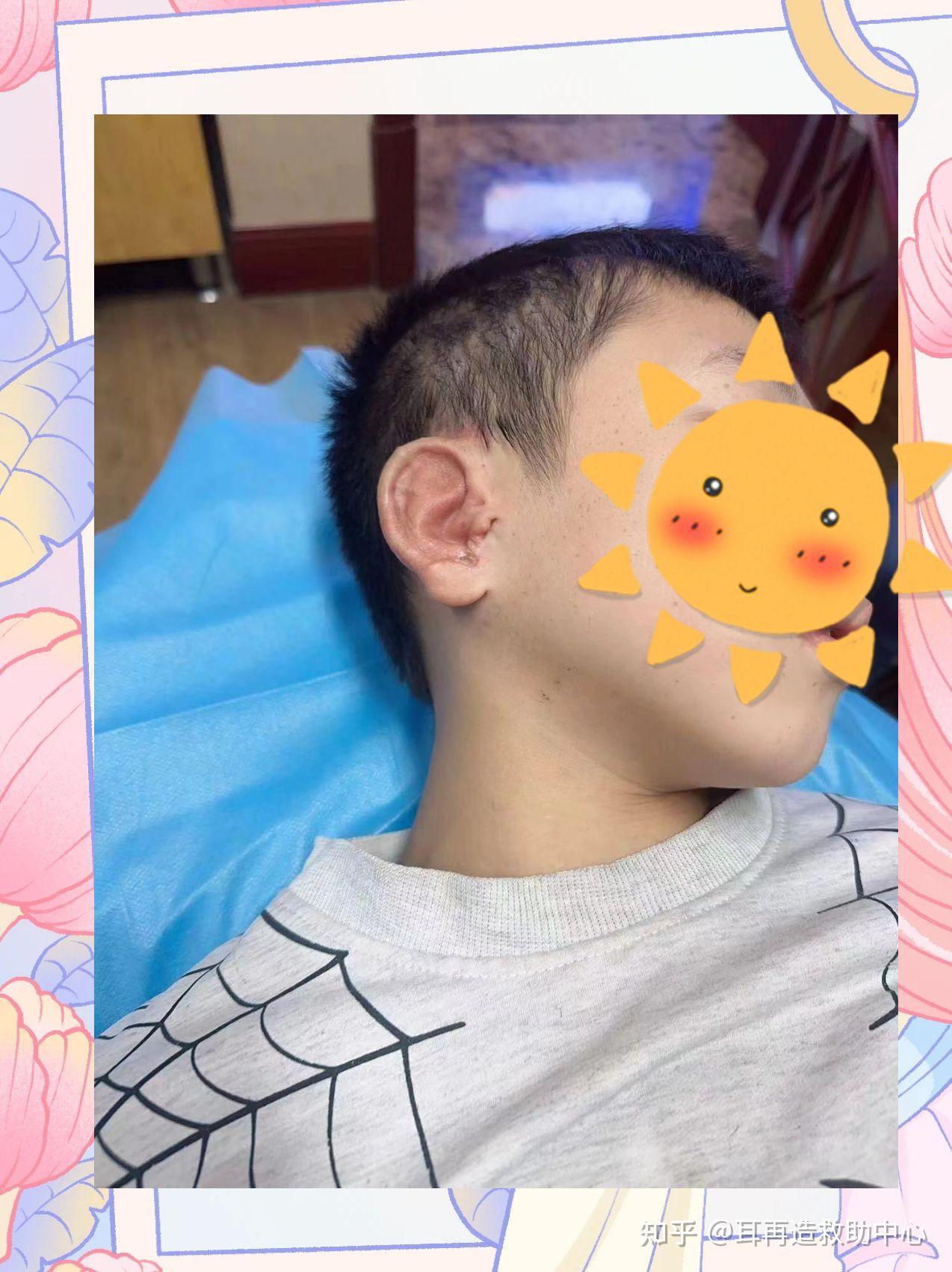 婴儿耳朵卷矫正,正常耳朵,婴儿斜颈图片_大山谷图库