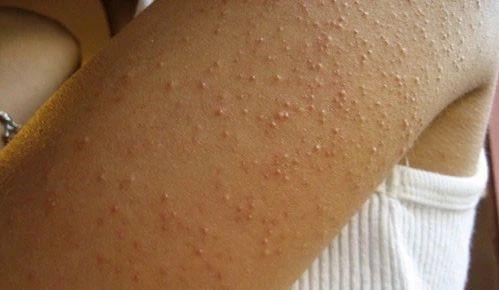 大腿鸡皮肤不痛不痒(腿部皮肤鸡皮肤怎么办)