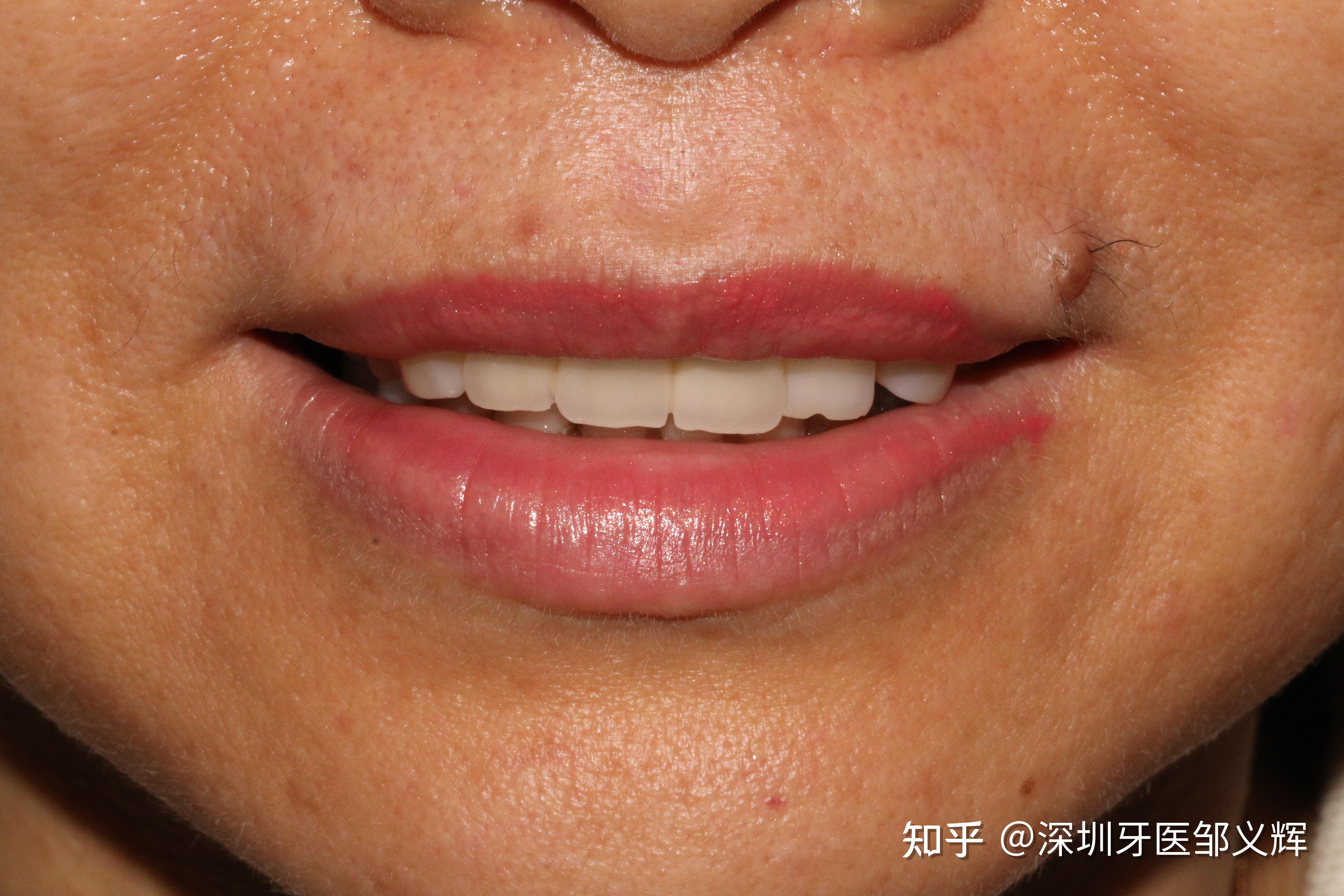 前牙骨量不足高笑线修复思路