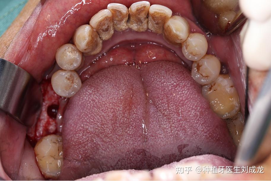 郑州瑞士iti种植牙医生刘成龙72岁患者磨牙区单颗种植案例