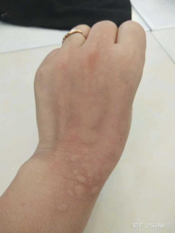 美女17年荨麻疹,如今只用这几招,3月消失无影踪