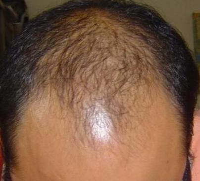 为什么秃顶只秃头顶而不秃两边呢