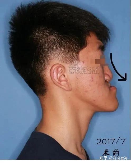 案例分享 | 正颌前后容貌变化能有多大? - 知乎