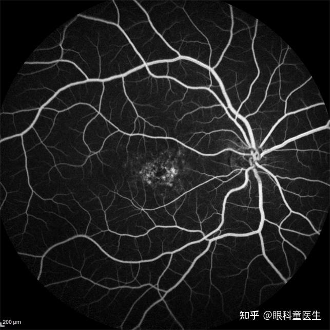 视网膜变性疾病6stargardt病