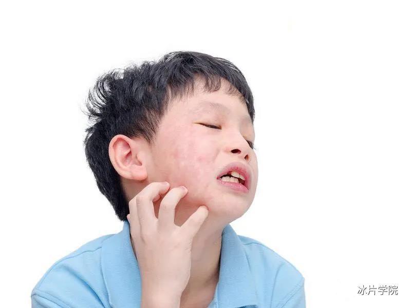 痤疮粉刺毛孔粗大皮肤瘙痒别让螨虫毁了你的脸