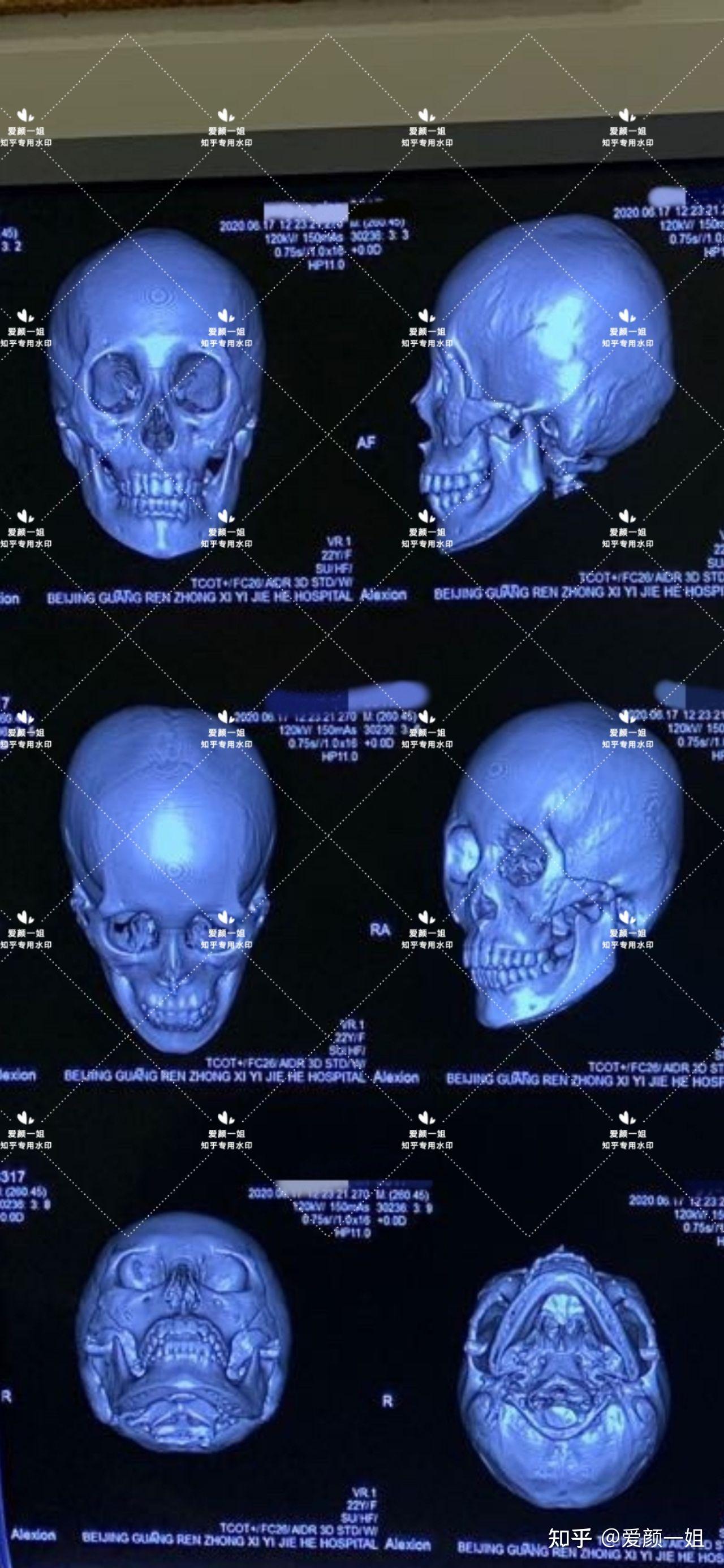 最近好多姐妹来问颧骨颧弓内推手术方式怎么选