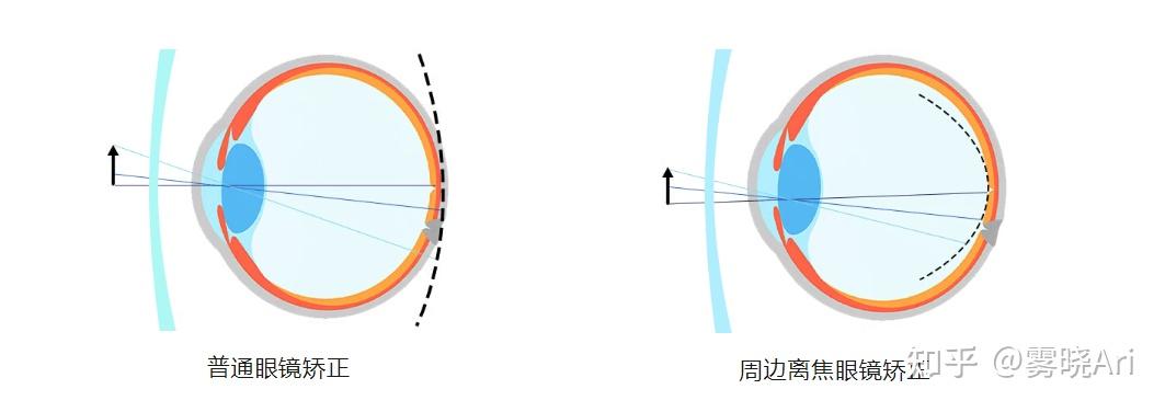 泉州近视手术专家科普:孩子戴了离焦镜,度数为什么还是飞涨? - 知乎