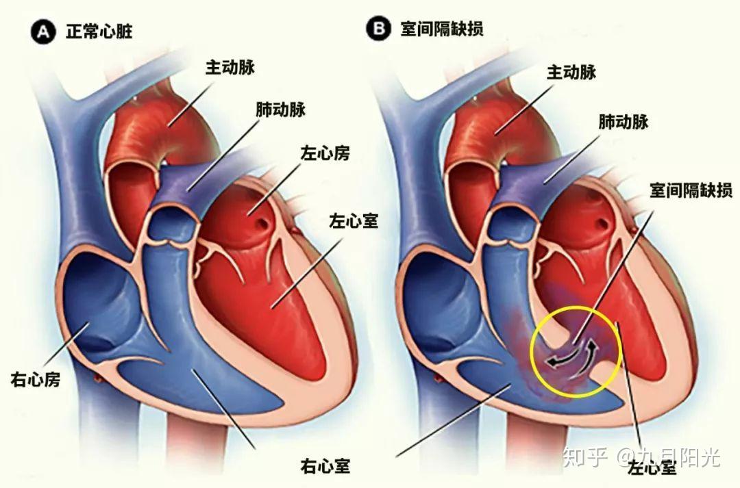 房间隔缺损室间隔缺损核保