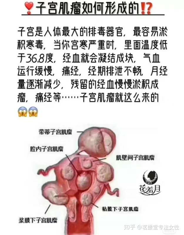 婦科小知識子宮肌瘤是如何形成的