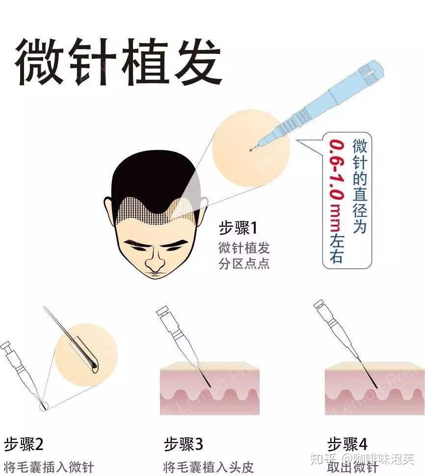 大麦微针植发前后对比，为妈生完美发际线鼓掌 - 知乎