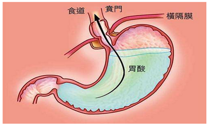 胃炎康復記7慢性胃炎伴膽汁反流調養經驗分享