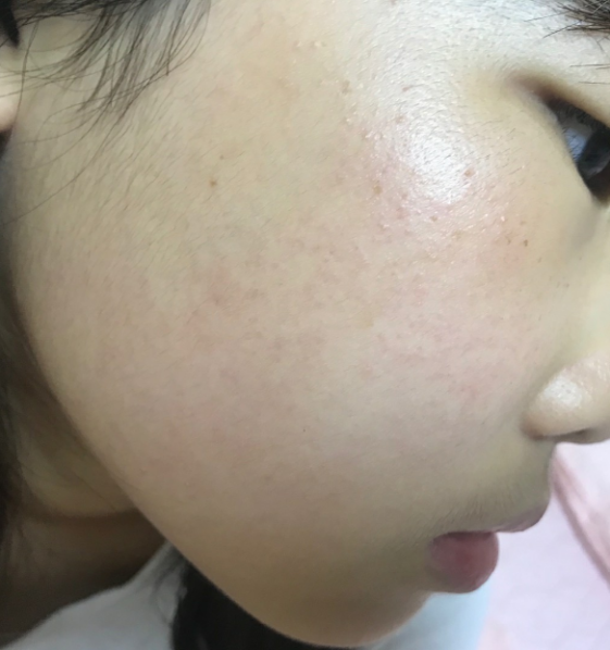 儿童特应性皮炎：毛周角化症改善过程 - 知乎