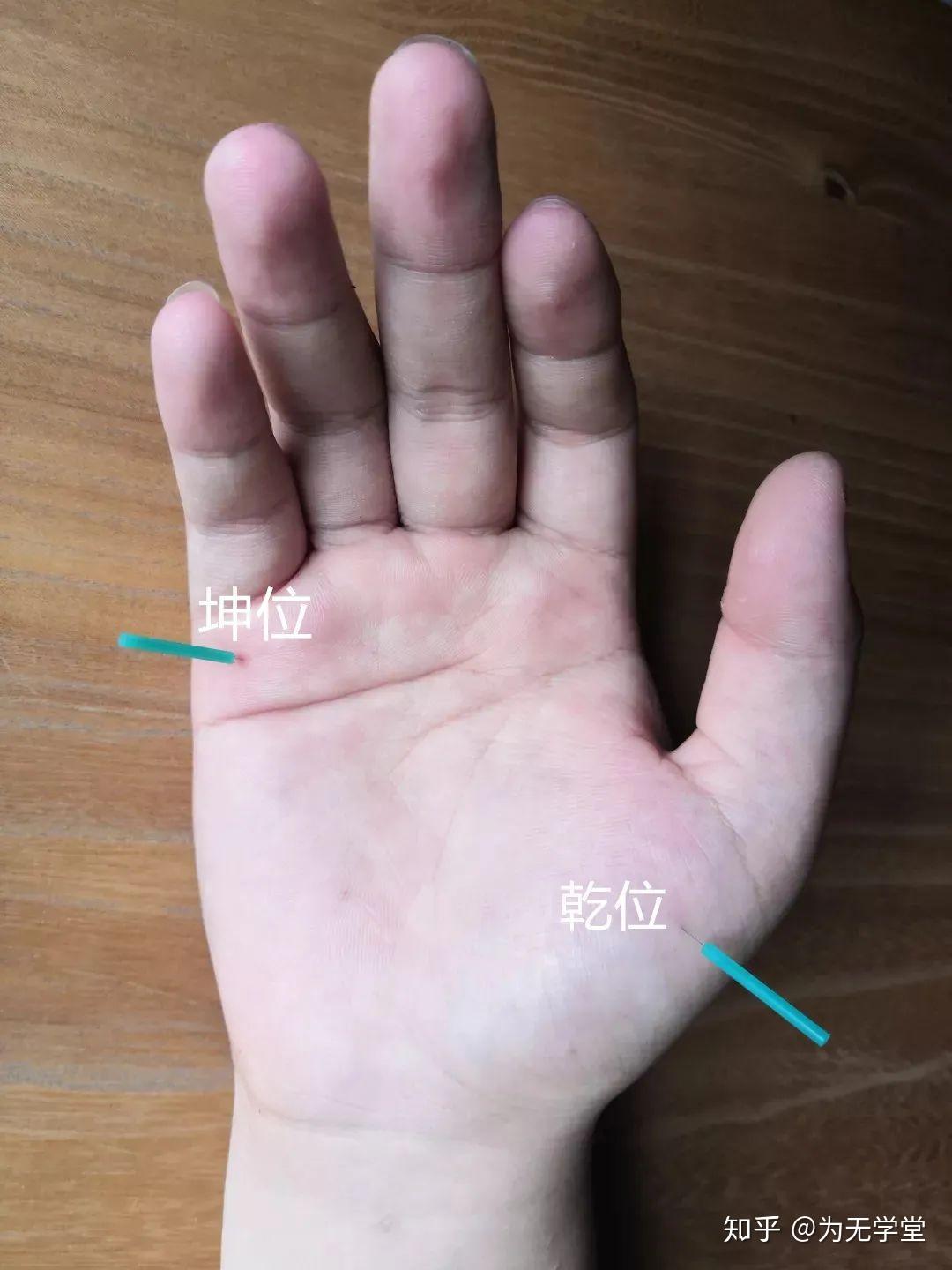 四扇门针刺针法解释:四扇门位于食指与拇指指之间,子宫肌瘤多与肝脾