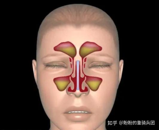出现这两种症状，你的鼻炎可能已经变成了鼻窦炎 - 知乎