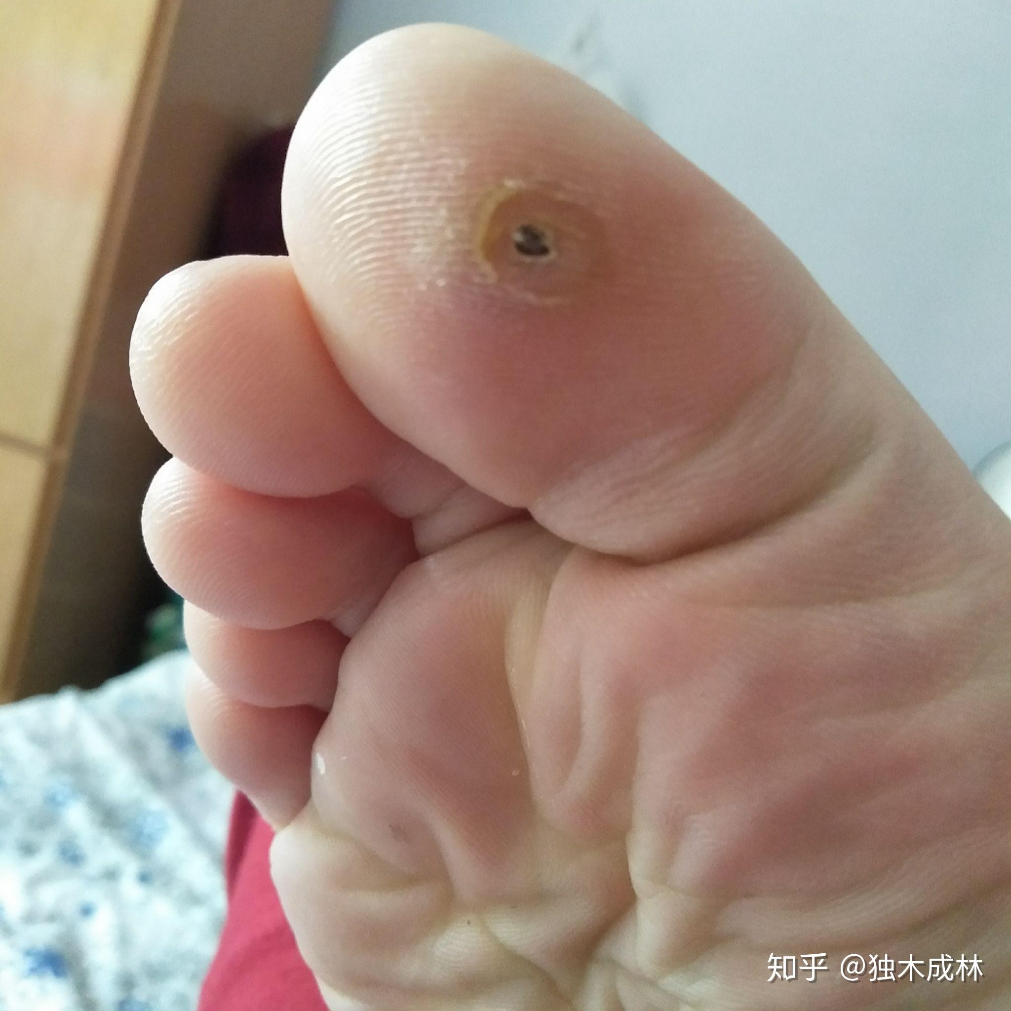 这是一个关于脚上跖疣的过程