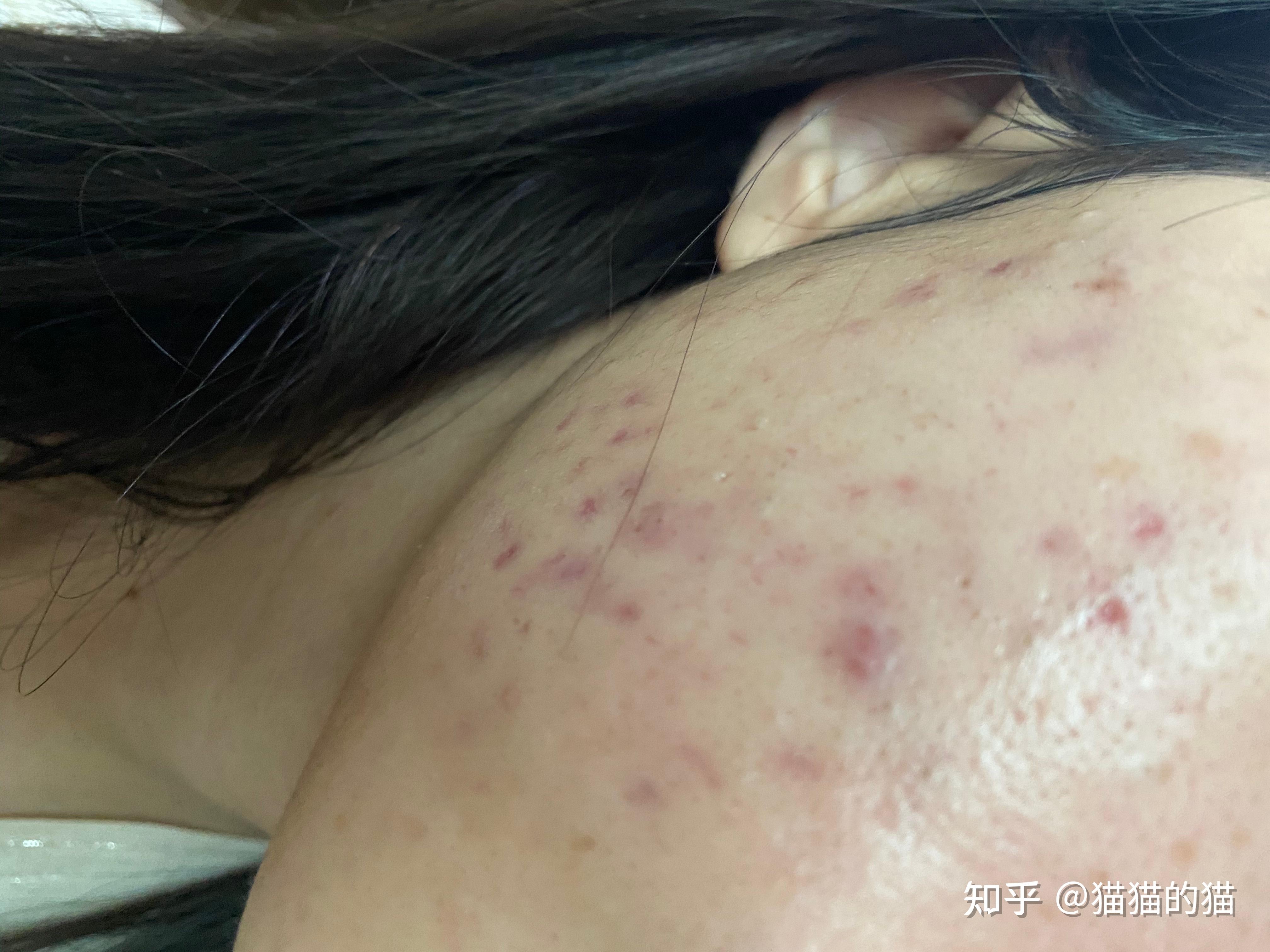 记录一下强脉冲光治疗痘印